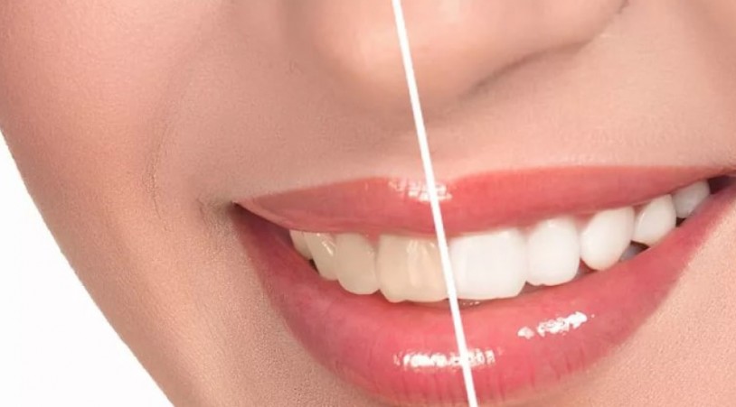 Как сохранить зубы белыми