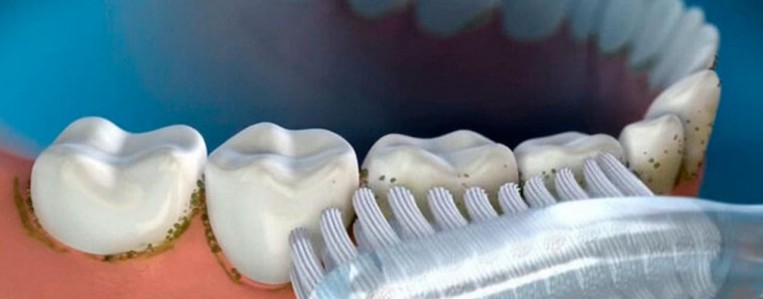 Причины появления зубных камней